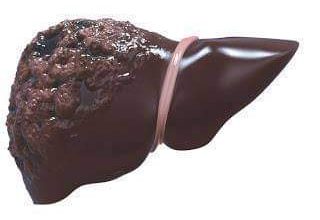 صورة الصحة تناشد مرضى التليف الكبدي بضرورة المتابعة الدورية