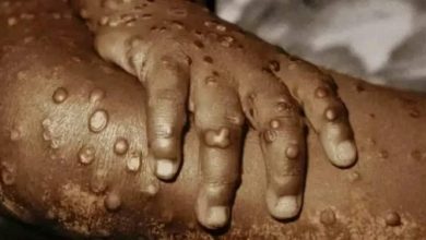 صورة عزل أول حالة مصابة بجدري القرود فى مصر