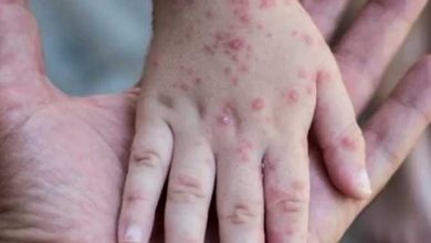 صورة ظهور حالة جديدة لفيروس جدرى القرود