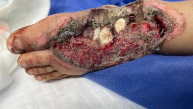 صورة معجزة طبية بمستشفى “الشيخ زايد”.. إنقاذ قدم طفل بعد حادث سير مروع