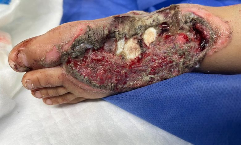 مستشفى الشيخ زايد التخصصي ينجح فى انقاذ قدم طفل من البتر