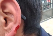 صورة طالب يفقد جزءًا من أذنه إثر اعتداء داخل مدرسة بالإسكندرية