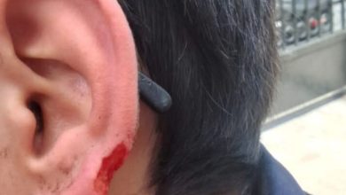 صورة طالب يفقد جزءًا من أذنه إثر اعتداء داخل مدرسة بالإسكندرية