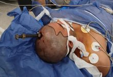 صورة نجاح أطباء قصر العيني في استخراج مسمار اخترق الجمجمة
