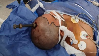 صورة نجاح أطباء قصر العيني في استخراج مسمار اخترق الجمجمة